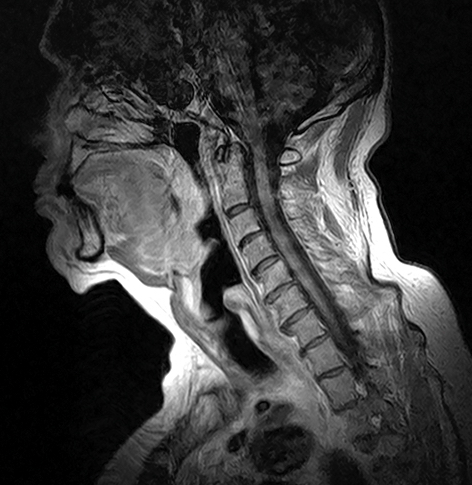 Soft tissue neck MRI scan